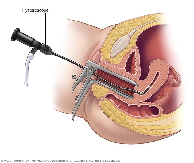 3 uterine polyps causes symptoms treatment 135700526 Polyp tử cung là bệnh gì? Ngăn chặn và điều trị như thế nào?