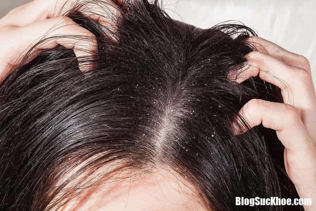 photo 1 154860020336283216085 Những thói quen này đang gây hại nghiêm trọng cho da đầu của bạn