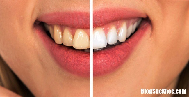 sau rang 5 15487346246681185633202 Làm trắng răng và ngừa sâu răng hiệu quả nhờ thói quen sinh hoạt